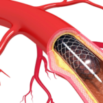 Kalp stenti nedir?