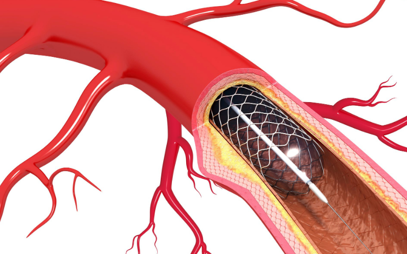 Kalp stenti nedir?